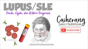Pandangan mata dipercaya bisa memengaruhi perasaan dan pikiran yang berdampak negatif bagi kesehatan. Kriteria Diagnosis Sle Systemic Lupus Erythematosus Kedokteran Caiherang
