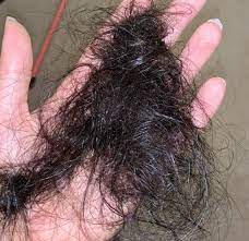 What is a very low calorie diet (vlcd)? Hair Shedding After A Low Calorie Diet Donovan Hair Clinic