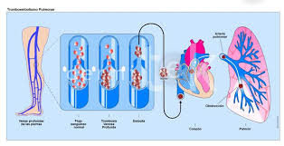 Trombosis venosa profunda, heparina de bajo peso molecular, ultrasonografía, fondaparinux, dimero d. Como Prevenir La Trombosis Venosa Profunda Tvp