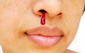As citrus fruits contain bioflavonoids, consume a citrus fruit once in a day. What Causes Nosebleeds Surprising Reasons Your Nose Is Bleeding The Healthy