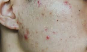 The first case of marburg virus ever recorded in west africa has been identified in guinea, according to a world health organization (who) report on tuesday. Nice Recommends Mental Health Support For Those Badly Affected By Acne Health The Guardian