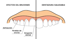 Bruxismo, síntomas y tratamiento definitivo - Hospital Fuensanta