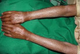 Image result for Systemic Sclerosis