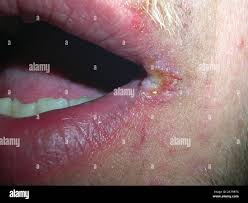 Image result for Angular Stomatitis