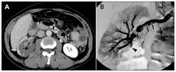 Image result for Renal Infarction