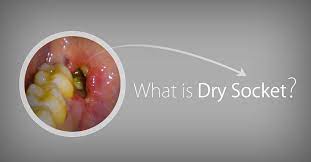 What Is A Dry Socket Dry Socket Dental Health Emergency Dental Care