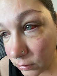 Sad to be missing Leann McCormick Wente's challenge class again but still  feeling pretty rundown from bronchitis. Forgot how bad it can get you down.  On a good note, after having eye