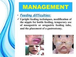 Pierre Robin Syndrome