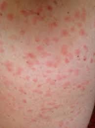 Images Of Turkey Mite Bites