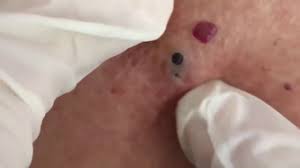 The suspense of waiting for each plug to be extracted is equal parts gruesome and addicting. Deep Blackheads Removal From Cheeks And Nose Best Pimple Popping Videos 2019 How To Remove Cystic Pimple Popping Videos