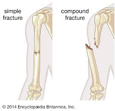 Image result for Fracture