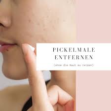 Pickelmale Entfernen 13 Tipps Fur Umwerfend Reine Haut