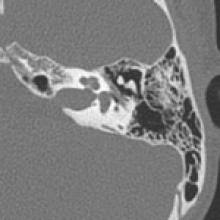 Image result for Ossicular Chain Disruption