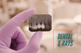 X Rays Were Discovered In 1895 By Wilhelm Conrad Roentgen Who Was A Professor At Wuerzburg University In Germany The Fi Oral Health Dental Care Dental Surgery