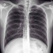 A Future Cardiologist I Have Sent This X Ray Has No Idea What S Wrong Help Him Please Radiology X Ray Radiology Imaging