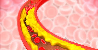 Bacteria attach to the teeth in layer upon layer. Suburban Imaging Calcium Build Up In Your Blood Dangers And Symptoms