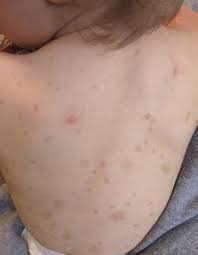 Image result for Urticaria pigmentosa children