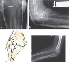 Image result for Radial Head Dislocation