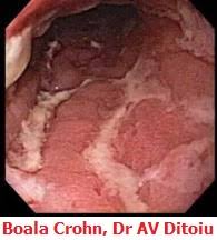 Boala crohn este o boala cronica in care intestinul se inflameaza si apar ulceratii. Boala Crohn Cabinet De Gastroenterologie Bucuresti