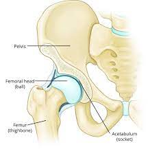While bone pain is the main symptom of bone cancer, and pain in the hip bone can be an indication of a tumor in the hip, there are often more likely other explanations for hip pain. Transient Osteoporosis Of The Hip Orthoinfo Aaos