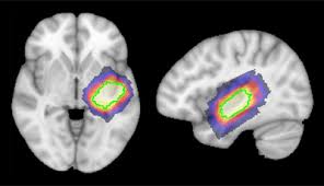 Surgical correction of the craniofacial dysmorphology of apert syndrome//clin. Imaging Shows Loss Of Brain Chemical In Autism Spectrum Autism Research News