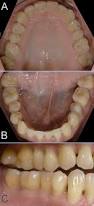 Image result for Occlusal