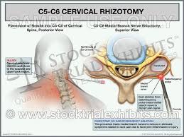 C5 C6 Cervical Rhizotomy Trial Exhibit Male Cervical Radiofrequency Ablation Medical Malpractice Cases
