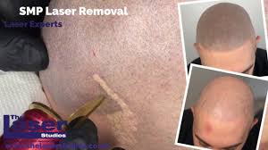 Maybe you would like to learn more about one of these? Absolute Full Smp Laser Removal At Our Specialist Scalp Micropigmentation Removal Clinic Near London Youtube