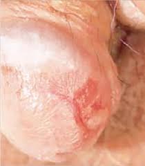 Image result for penis mycosis symptoms