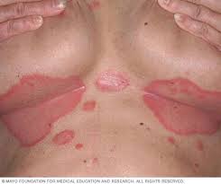 Image result for psoriasis