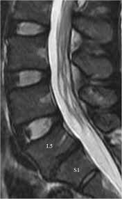 In a prospective multicenter study, two blinded raters independently examined cervical spine magnetic resonance (mr) images of 140 healthy . Mri Detected Spinal Disc Degenerative Changes In Athletes Participating In The Rio De Janeiro 2016 Summer Olympics Games Bmc Musculoskeletal Disorders Full Text