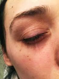 It usually lasts for two to five days. Eyelid Eczema Treatment Holisitic Healing Regimen Eye Loves Cares Eye Love Cares