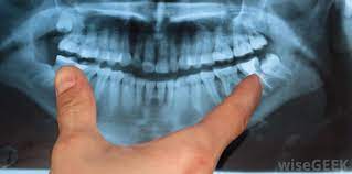 Feelings pain, hurt, and swelling are some of the other conditions, like osteoporosis or arthritis, may also cause bone or joint pain. What Is Jaw Bone Cancer With Pictures