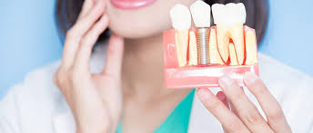 Dental Implant Stages What To Expect When Getting Implant Surgery Aurora Family Dentistry