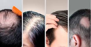 Should you notice a receding hairline or thinning hair at the crown of your head, the first thing to remember is that you're far from alone. Hair Shedding What You Should Know Pcos Awareness Association