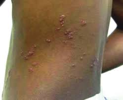 Image result for herpes zoster