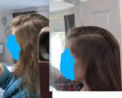 To reap the benefits of clary sage for hair, try the diy recipe below. 24 Days Progress Rosemary And Peppermint Oil And Microneedling No Drugs Haircarescience