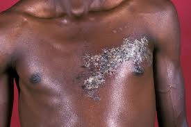 Image result for Varicella zoster on human skin
