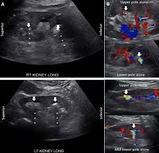 Liver Transplant Toxoplasmosis And Kidney Stones Connecting The Dots Bmj Case Reports
