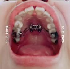 請益配戴上顎擴張前輩 - 牙齒矯正板 | Dcard