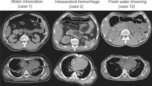 Image result for Water Intoxication