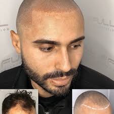FULL MICROPIGMENTATION