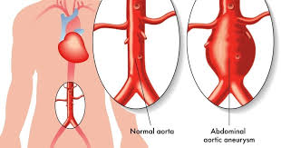 Aneurysm information including symptoms, diagnosis, treatment, causes, videos, forums, and local community support. Abdominal Aortic Aneurysm Aaa Familydoctor Org