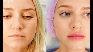 как убрать гиалуроновую кислоту из губ в домашних условиях Uvelichenie Gub 1 Ml Rezultat Do I Posle Youtube