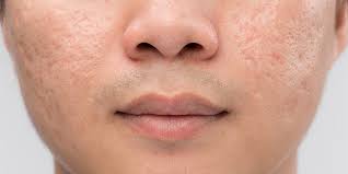 So i am getting surgery to remove them. Acne Scar Removal Treatment Cost In Chennai Laser Mnrf Peels Results And Reviews