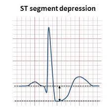 Depresi adalah penyakit yang sangat umum pada odha. St Depression Wikipedia