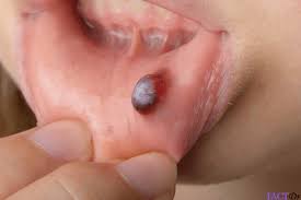 Blood Blister Factdr