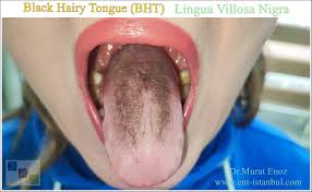 Image result for black hairy tongue symptoms