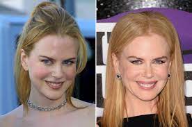 Was nicole kidman plastic surgery a hit or miss? Nicole Kidman Before And After The Skincare Edit