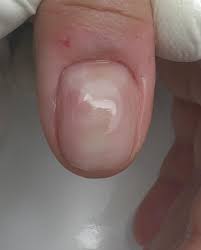 Image result for Onychotillomania feet